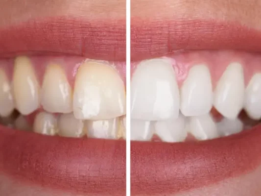 6 روش خانگی طبیعی سفید کردن دندان