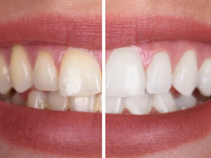 6 روش خانگی طبیعی سفید کردن دندان